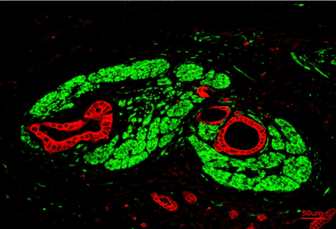치명적인 췌장암이 성장하는 방법 찾았다.
