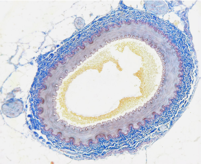 동맥경화: 위험한 플라크를 제거하는 새로운 항체 치료법