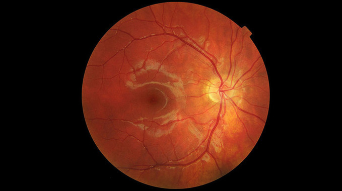 흡연, 폐뿐 아니라 눈에도 훨씬 심각한 손상입혀
